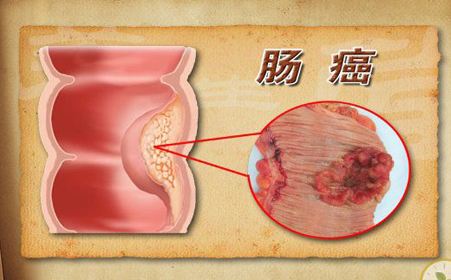 广州东大医院收费贵吗 控制腹部脂肪也可以有效预防大肠癌