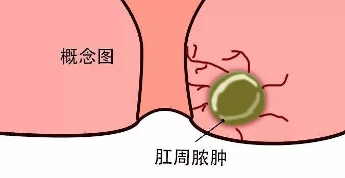 广州东大肛周脓肿.jpg