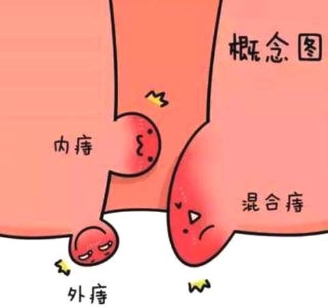 广州东大肛肠医院——痔疮.jpg