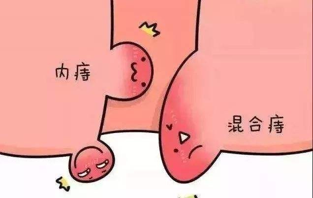 广州东大肛肠医院——痔疮.jpg