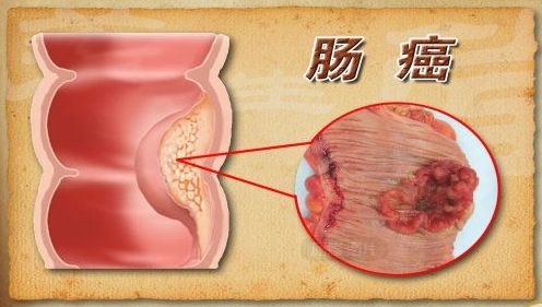 广州东大肛肠医院——肠癌.jpg