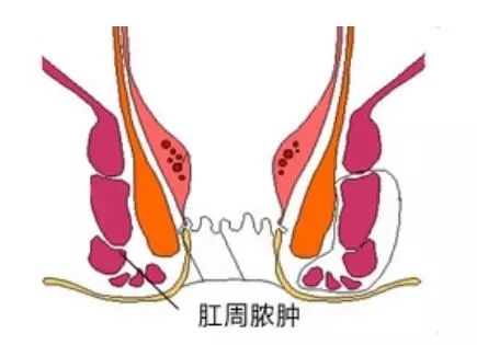 广州东大肛肠医院——肛周脓肿
