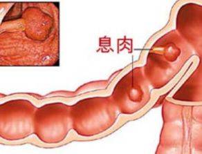 广州东大肛肠医院——直肠息肉.jpg